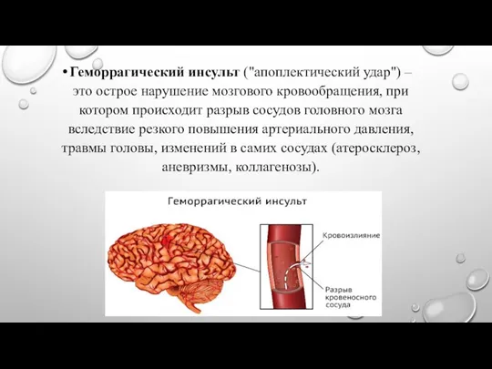 Геморрагический инсульт ("апоплектический удар") – это острое нарушение мозгового кровообращения,