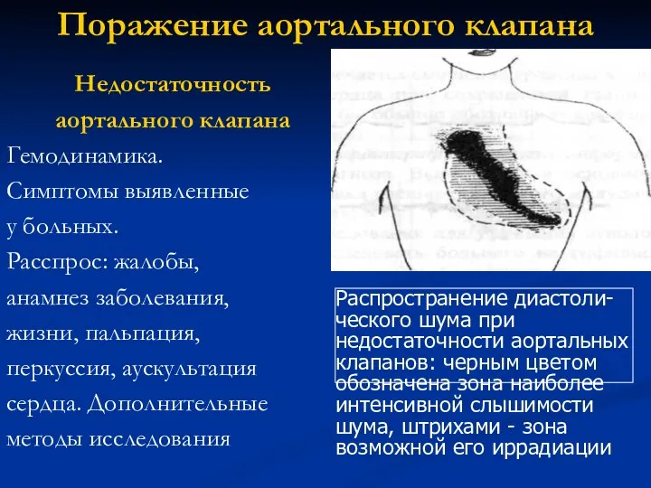 Поражение аортального клапана Недостаточность аортального клапана Гемодинамика. Симптомы выявленные у