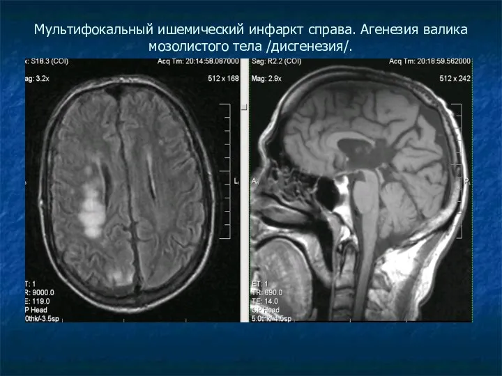 Мультифокальный ишемический инфаркт справа. Агенезия валика мозолистого тела /дисгенезия/.