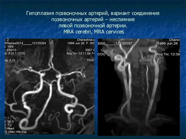 Гипоплазия позвоночных артерий, вариант соединения позвоночных артерий – неслияние левой позвоночной артерии. MRA cerebri, MRA cervices