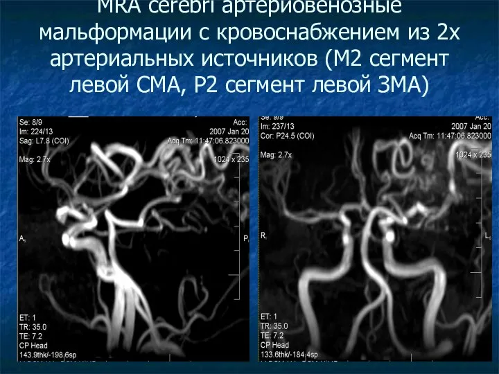 MRA cerebri артериовенозные мальформации с кровоснабжением из 2х артериальных источников