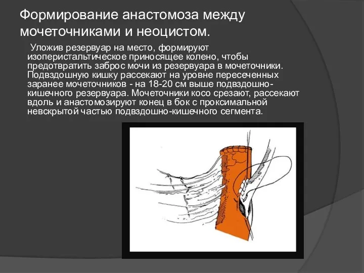 Формирование анастомоза между мочеточниками и неоцистом. Уложив резервуар на место,