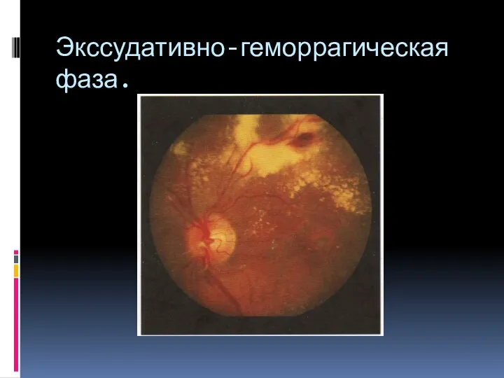 Экссудативно-геморрагическая фаза.