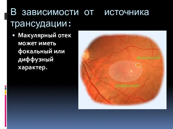 В зависимости от источника трансудации: Макулярный отек может иметь фокальный или диффузный характер. фокальный диффузный