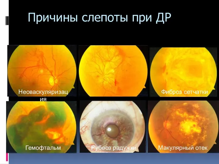 Причины слепоты при ДР Неоваскуляризация Гемофтальм Рубеоз радужки Макулярный отек Фиброз сетчатки