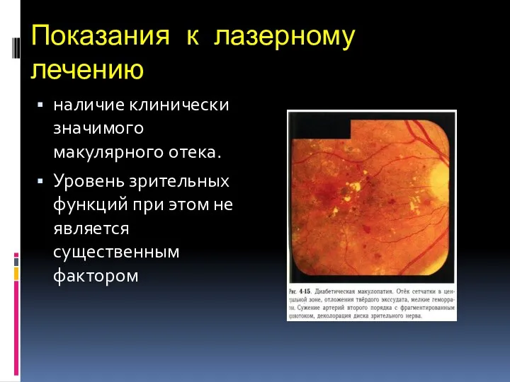 Показания к лазерному лечению наличие клинически значимого макулярного отека. Уровень