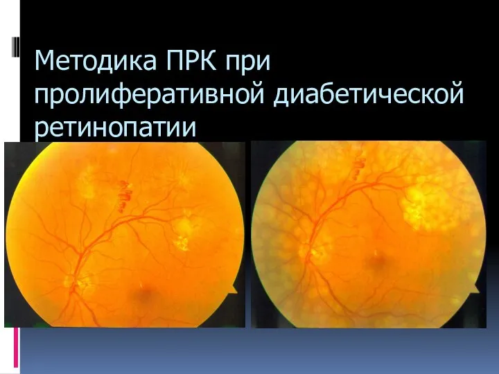 Методика ПРК при пролиферативной диабетической ретинопатии