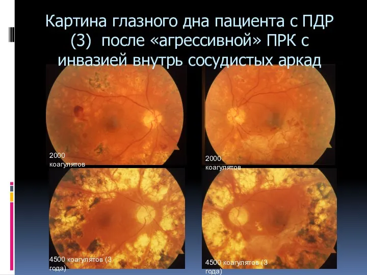 Картина глазного дна пациента с ПДР(3) после «агрессивной» ПРК с