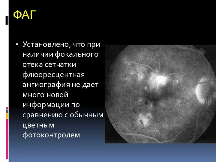 ФАГ Установлено, что при наличии фокального отека сетчатки флюоресцентная ангиография