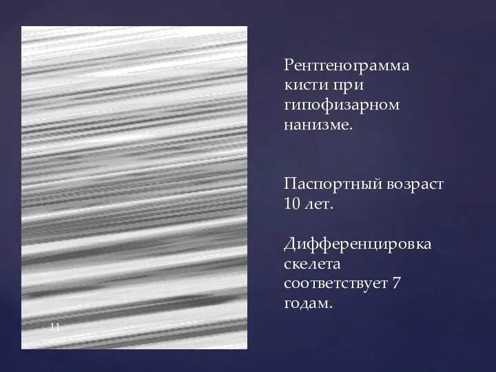 Рентгенограмма кисти при гипофизарном нанизме. Паспортный возраст 10 лет. Дифференцировка скелета соответствует 7 годам.