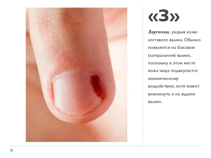 «З» Заусенец- разрыв кожи ногтевого валика. Обычно появляется на боковом