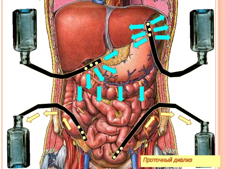 я Проточный диализ