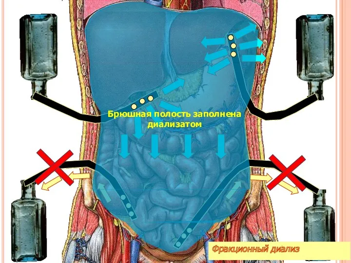 я Фракционный диализ Брюшная полость заполнена диализатом