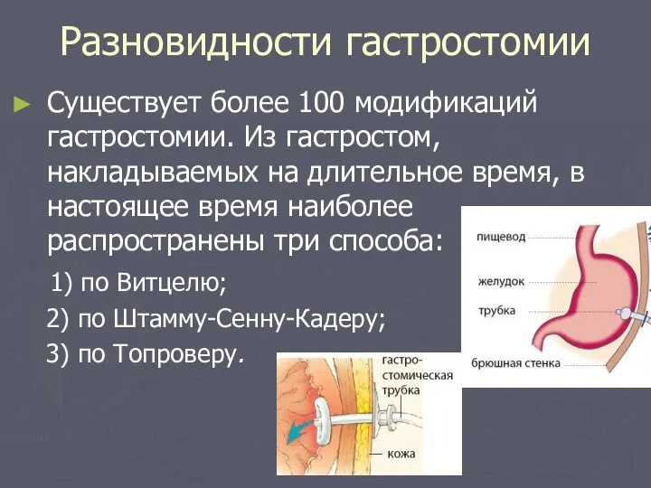 Разновидности гастростомии Существует более 100 модификаций гастростомии. Из гастростом, накладываемых