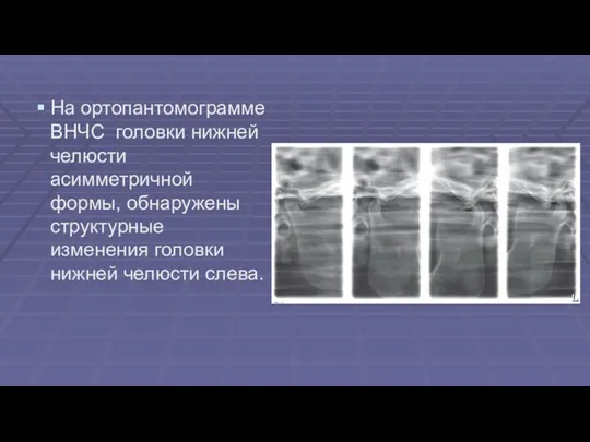 На ортопантомограмме ВНЧС головки нижней челюсти асимметричной формы, обнаружены структурные изменения головки нижней челюсти слева.