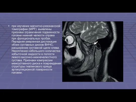 при изучении магнитно-резонансной томографии (МРТ) выявлены признаки ограничения подвижности головки