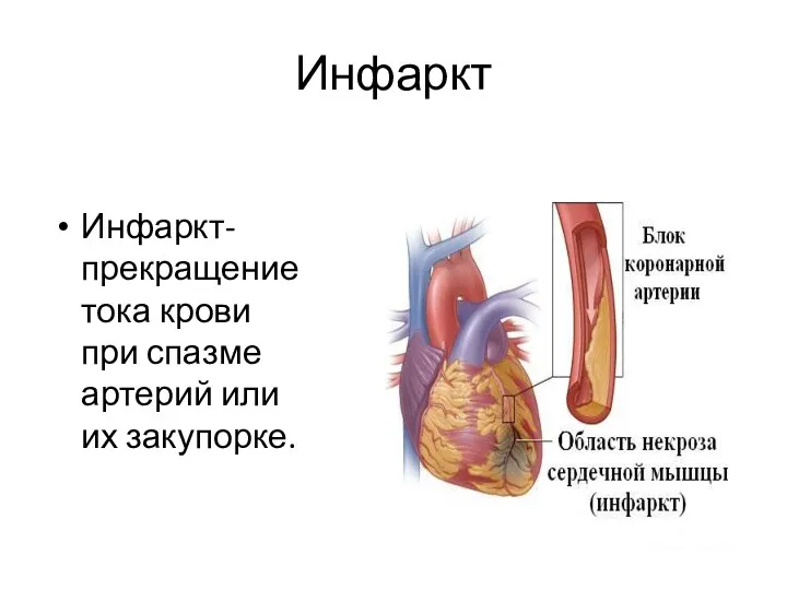Инфаркт Инфаркт-прекращение тока крови при спазме артерий или их закупорке.