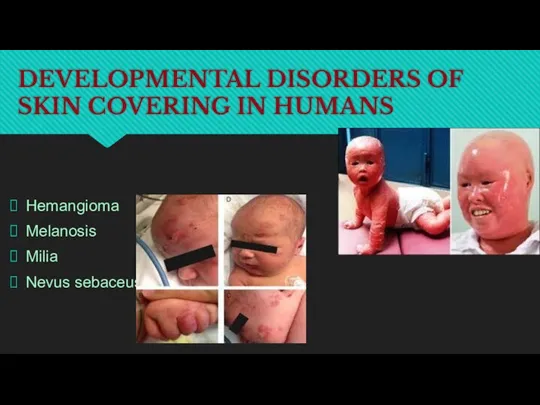 DEVELOPMENTAL DISORDERS OF SKIN COVERING IN HUMANS Hemangioma Melanosis Milia Nevus sebaceus