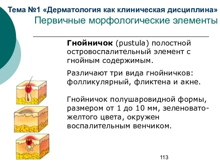 Тема №1 «Дерматология как клиническая дисциплина» Первичные морфологические элементы Гнойничок