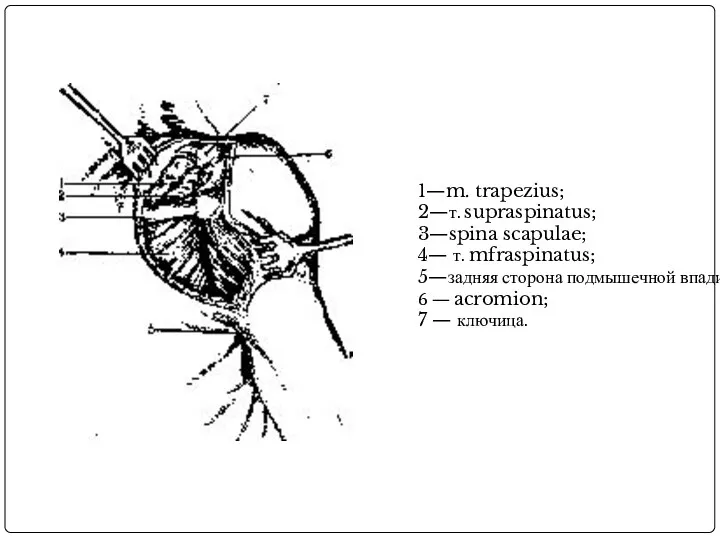 1—m. trapezius; 2—т. supraspinatus; 3—spina scapulae; 4— т. mfraspinatus; 5—задняя