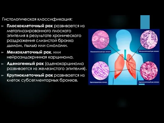 Гистологическая классификация: Плоскоклеточный рак развивается из метаплазированного плоского эпителия в