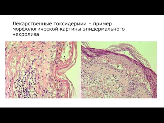 Лекарственные токсидермии – пример морфологической картины эпидермального некролиза