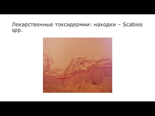 Лекарственные токсидермии: находки – Scabies spp.