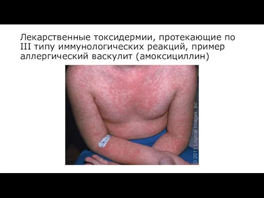 Лекарственные токсидермии, протекающие по III типу иммунологических реакций, пример аллергический васкулит (амоксициллин)