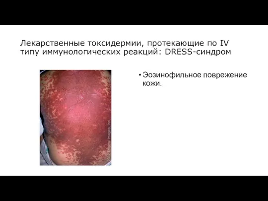 Лекарственные токсидермии, протекающие по IV типу иммунологических реакций: DRESS-синдром Эозинофильное поврежение кожи.
