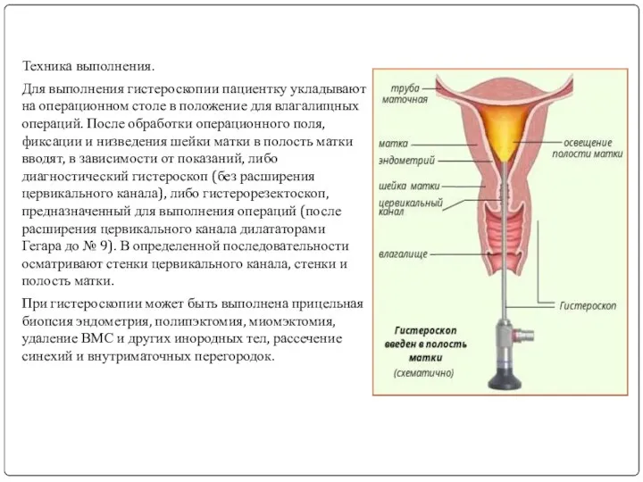 Техника выполнения. Для выполнения гистероскопии пациентку укладывают на операционном столе