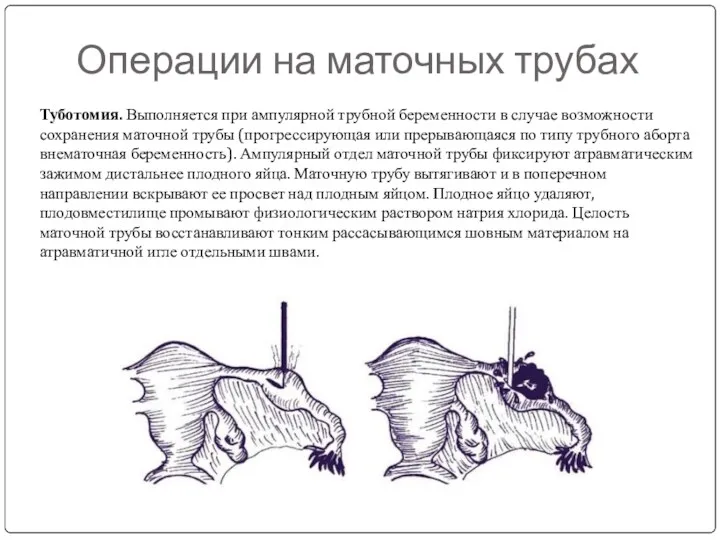 Операции на маточных трубах Туботомия. Выполняется при ампулярной трубной беременности