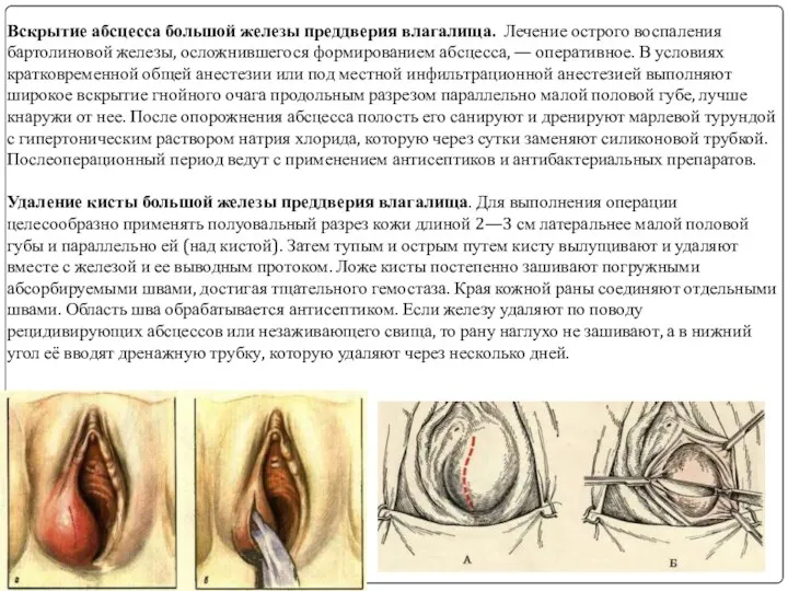 Вскрытие абсцесса большой железы преддверия влагалища. Лечение острого воспаления бартолиновой