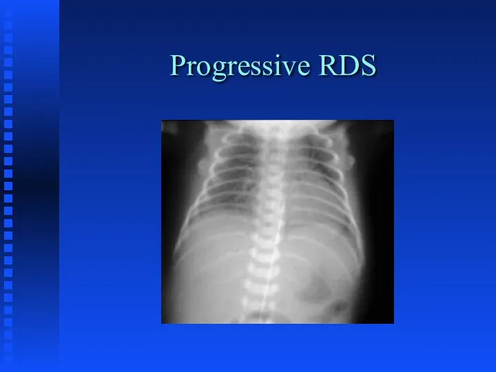 Progressive RDS