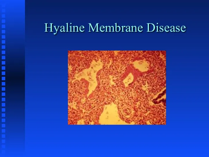 Hyaline Membrane Disease