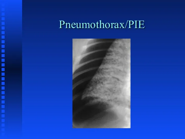 Pneumothorax/PIE