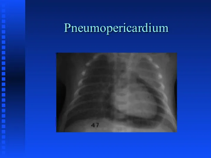 Pneumopericardium