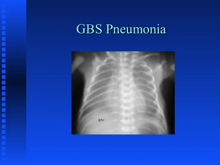 GBS Pneumonia