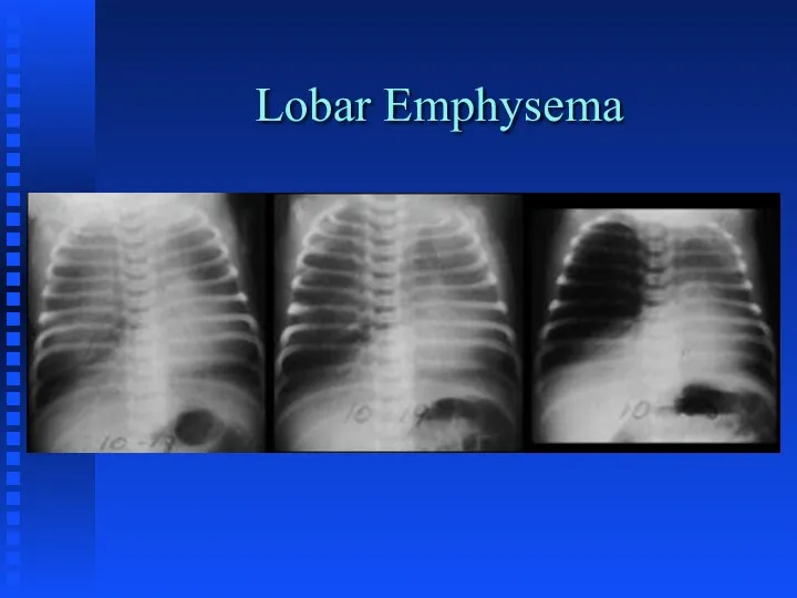 Lobar Emphysema