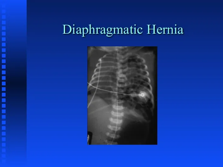 Diaphragmatic Hernia