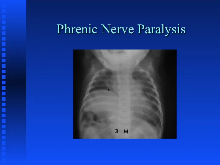 Phrenic Nerve Paralysis