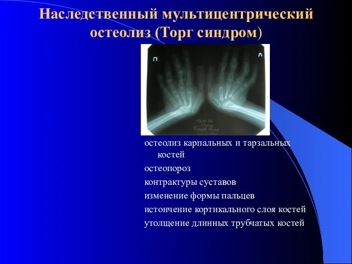 Наследственный мультицентрический остеолиз (Торг синдром) остеолиз карпальных и тарзальных костей