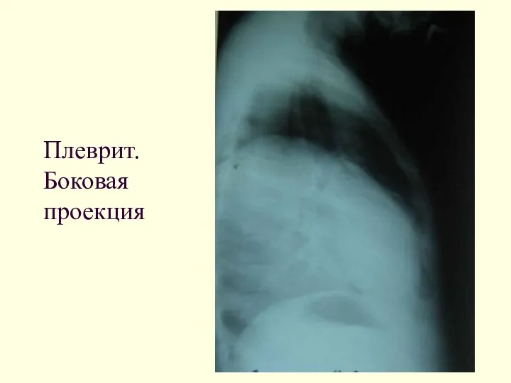 Плеврит. Боковая проекция