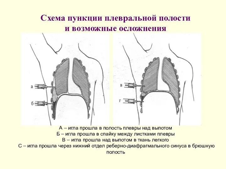 Схема пункции плевральной полости и возможные осложнения А – игла