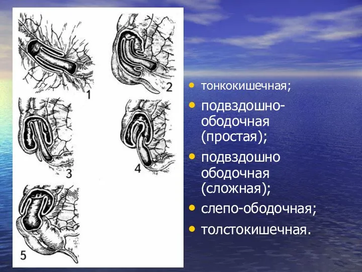 тонкокишечная; подвздошно-ободочная (простая); подвздошно ободочная (сложная); слепо-ободочная; толстокишечная.