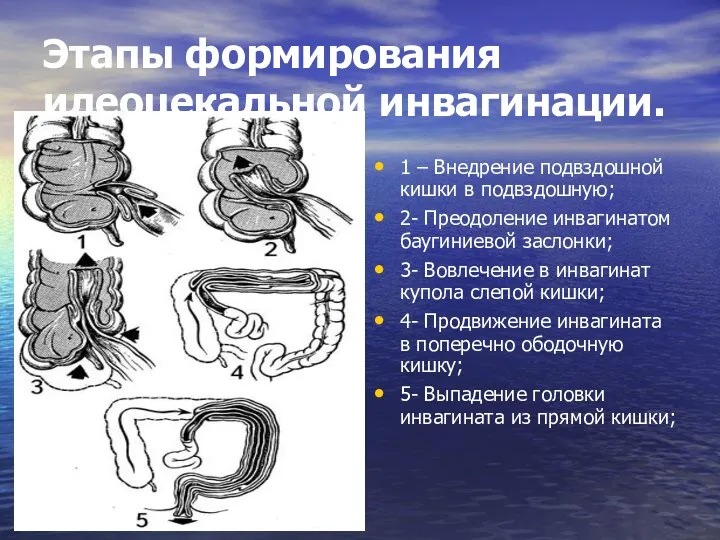 Этапы формирования илеоцекальной инвагинации. 1 – Внедрение подвздошной кишки в подвздошную; 2- Преодоление