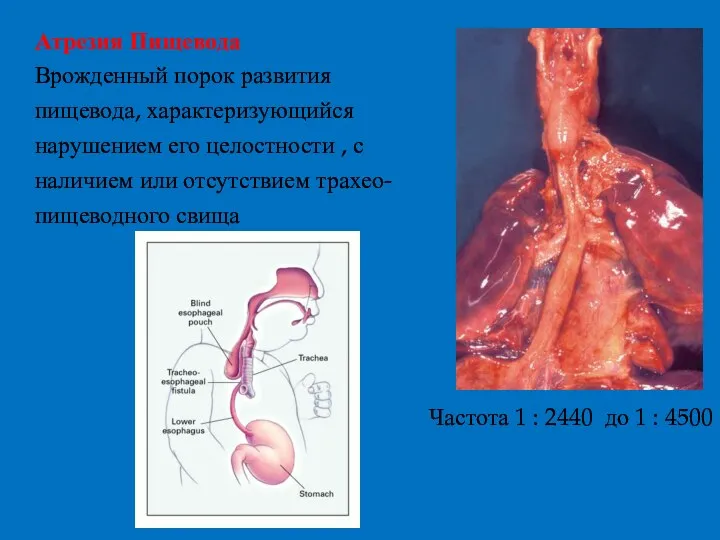 Атрезия Пищевода Врожденный порок развития пищевода, характеризующийся нарушением его целостности