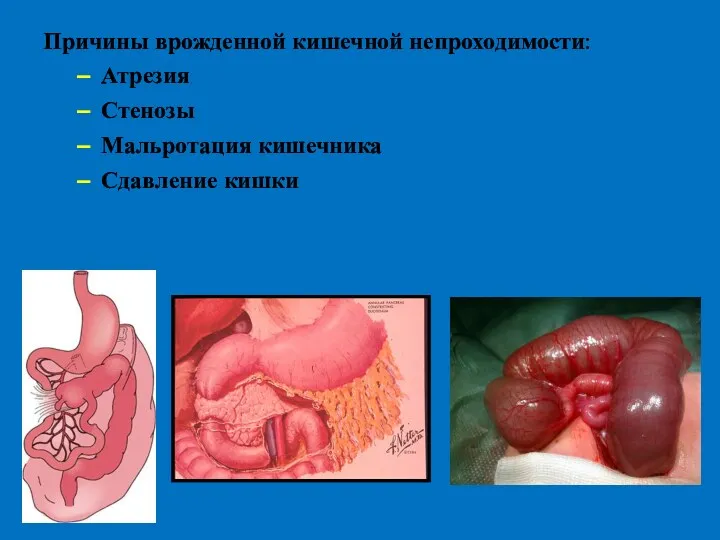 Причины врожденной кишечной непроходимости: Атрезия Стенозы Мальротация кишечника Сдавление кишки