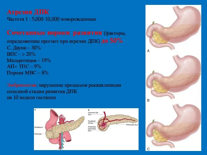 Атрезия ДПК Частота 1 : 5,000-10,000 новорожденных Сочетанные пороки развития