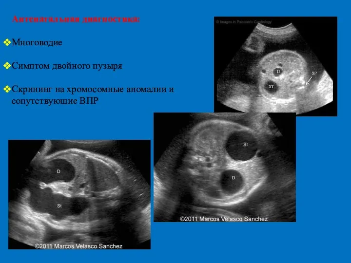 Антенатальная диагностика: Многоводие Симптом двойного пузыря Скрининг на хромосомные аномалии и сопутствующие ВПР
