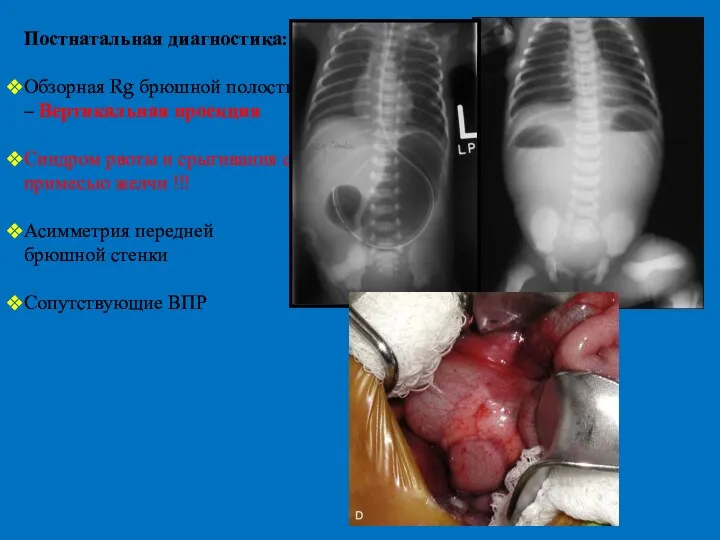Постнатальная диагностика: Обзорная Rg брюшной полости – Вертикальная проекция Синдром